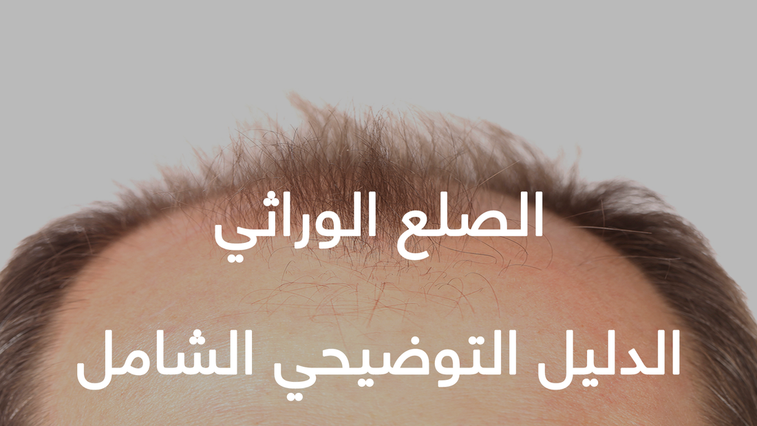 الصلع الوراثي : الدليل التوضيحي الشامل